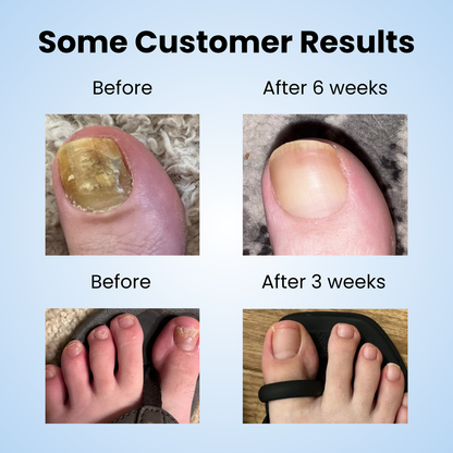 NOURVA overnight nail renewal patches