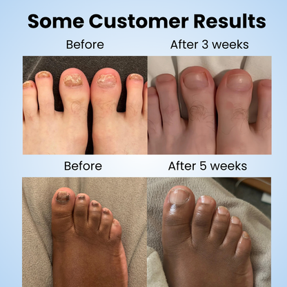 NOURVA overnight nail renewal patches